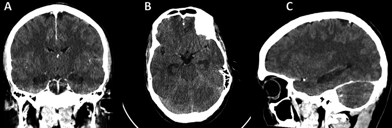 CT scan findings indicative of bilateral toxic-ischemic encephalopathy. CT scans display coronal, axial, and sagittal views from left to right. The scans reveal no evidence of acute hemorrhagic events either within or surrounding the brain tissue. Symmetrical hypodensity is noted in the bilateral globus pallidus and hippocampi, with less pronounced hypodensity in the bilateral occipital lobes. No enhancement was observed post-intravenous contrast injection. These patterns are consistent with a primary diagnosis of toxic encephalopathy. The ventricular system is unremarkable in morphology and size, with the midline structures remaining centralized. Basal cisterns appear unobstructed. There is a partial opacification with mucosal characteristics in the right maxillary sinus. In summary, imaging findings are indicative of a toxic-ischemic encephalopathy characterized by bilateral and symmetrical hypodensities in both hippocampi and globus pallidus. Differential considerations may include carbon monoxide toxicity or central posterior reversible encephalopathy syndrome (PRES)