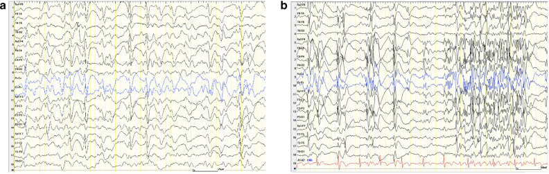 Typical EEG patterns in Lennox-Gastaut syndrome (LGS): a bilateral 1.5–2/second slow spike waves, and b bilateral high frequent rhythms 16–20/s in NREM sleep. EEG electroencephalogram, NREM non-rapid eye movement