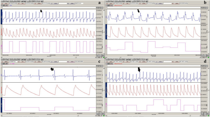 The following are examples of ECG (blue), BP (red), and HR (pink) signals obtained using the BIOPAC MP100 data acquisition system: Branch block (a), ST depression (b), atrioventricular block (c) and T negativity (d) in the ALD group
