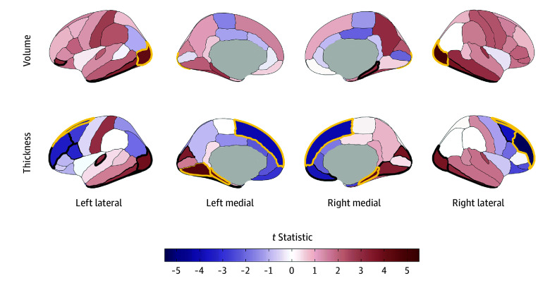 Regional Cortical Volume and Thickness Associations With Early Alcohol Use Initiation in the Adolescent Brain Cognitive Development (ABCD) StudyCortical volume and thickness patterning of associations with alcohol use initiation are plotted as t statistics (red indicates a positive association and blue indicates a negative association) according to the Desikan–Killiany cortical atlas.31 Regions with bold yellow outlines were Bonferroni-significant for all study comparisons, and those with bold black outlines exhibited false discovery rate (FDR)–significant associations (eTable 5 in Supplement 1). Regional brain plots were constructed using the ggseg package in R.43