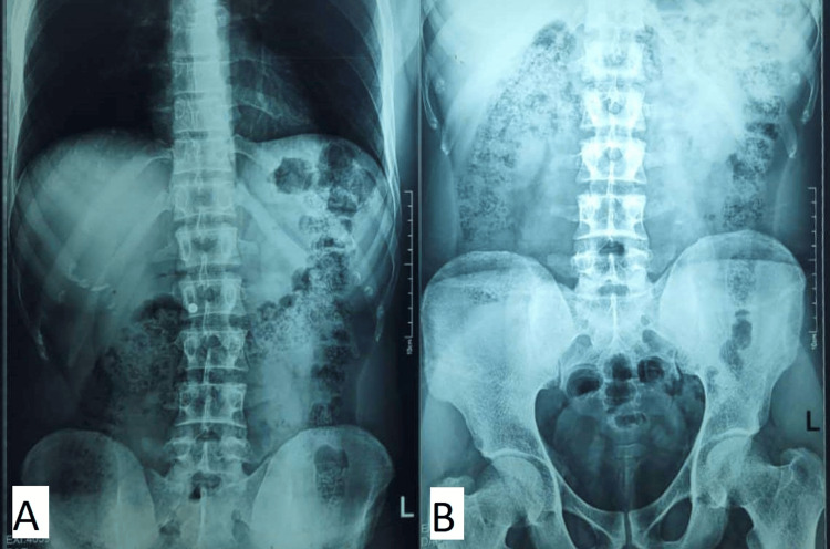 X-ray of the abdomen (PA view)Erect posture shows no sign of visceral perforation or air under the diaphragm (A). There is no sign of gastric distension or intestinal obstruction on a supine view (B).PA, posteroanterior.