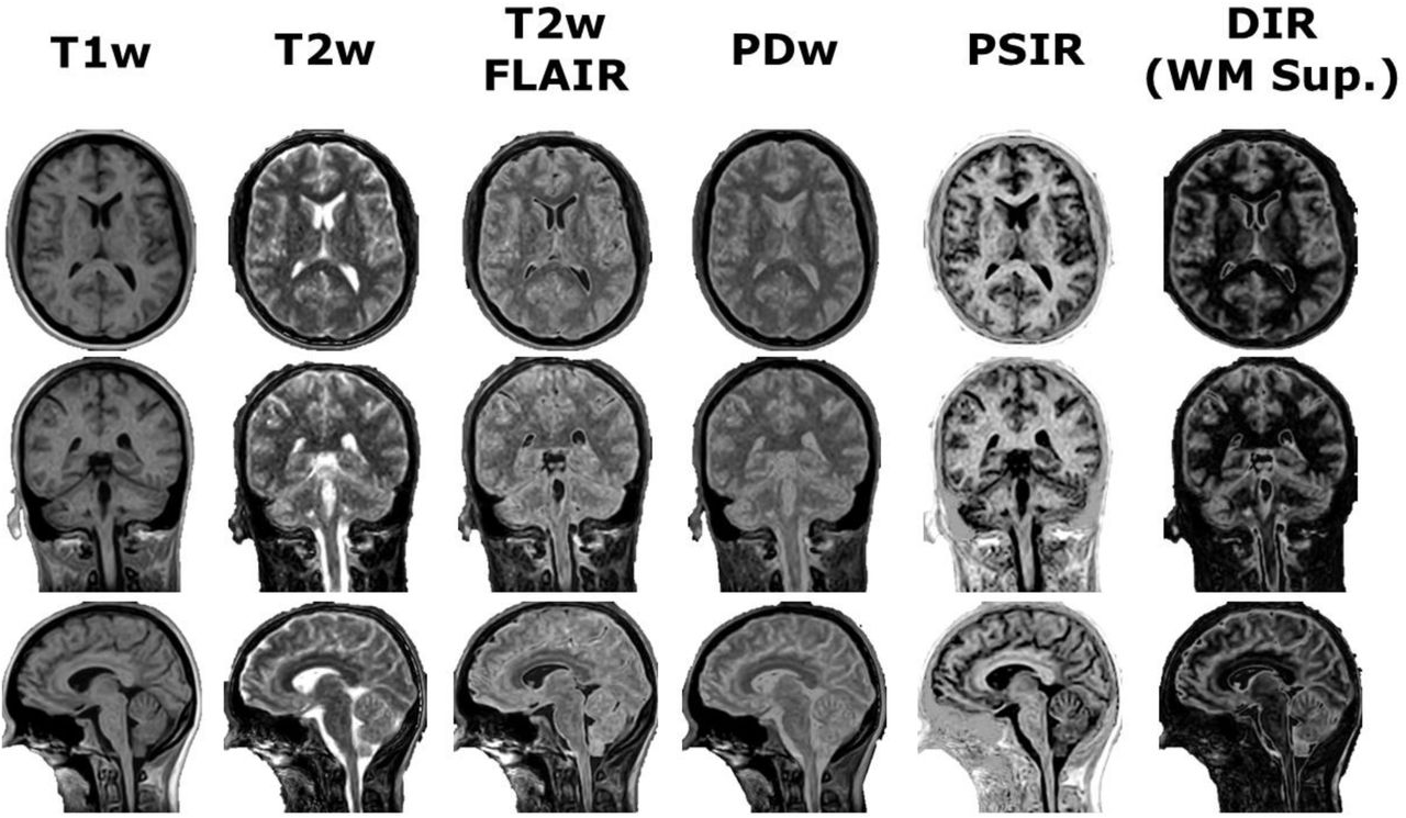 Demonstration of post-processing available from SyMRI combined with 3D-QALAS at high isotropic resolution in a healthy volunteer. Shown from left to right are the T1-weighted, T2-weighted, T2-weighted fluid attenuated inversion recovery (FLAIR), proton density-weighted, phase-sensitive inversion recovery (PSIR), and double inversion recovery (DIR) with white matter suppression synthetic images in the axial (top), coronal (middle), and sagittal (bottom) orientations.