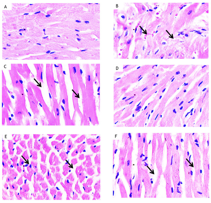 Effect of curcumin on the heart tissue in HFD-fed myocardial infarcted diabetic mice. (A) Light micrograph of normal group showing myocardial fibers are normal in structure and architecture. (B) HFD + STZ + ISO administered mice heart showing focal confluent necrosis of muscle fiber with inflammatory cell infiltration, oedema with fibroblastic proliferation along with extravasation of erythrocytes. (C) HFD + STZ + ISO + Cur (100) showing less myocardial injury, less oedema and inflammatory cells. (D) HFD + STZ + ISO + Cur (200) mice heart tissue showing mild oedema but without any signs of infarction. The myocardial fibers are normal in architecture. (E) HFD + STZ + ISO + Cur (200) + AM (1) showing marked myocardial necrosis, oedema with inflammatory cells infiltration. (F) HFD + STZ + ISO + AM (1) showing myocardial injury, oedema and inflammatory cells. The arrows indicate pathological changes in the myocardium.