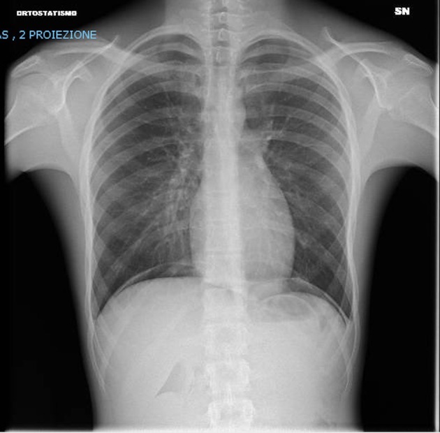 Chest x-ray after 48 h showing both lungs clear of significant parenchymal opacities and no signs of pleural effusions.