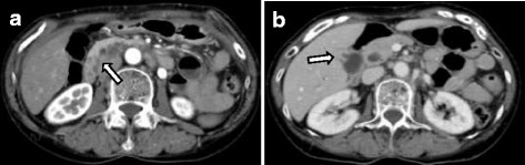 Abdominal computed tomography (CT). a Low-density mass and cystic lesions in the pancreatic head. b Thickness in the wall adjoining the bottom of the gallbladder