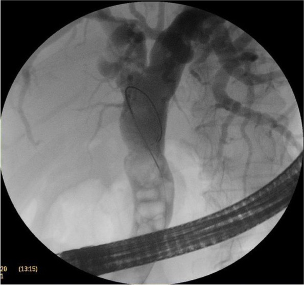 A cholangiogram showing mildly dilated CBD studded with multiple stones