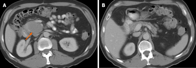 A 58-year-old male with abdominal pain. A: Axial computed tomography images demonstrate a large, relatively well-defined focal mass (arrow) involving the uncinate process of the pancreas; B: Axial computed tomography images. The tumor shows homogenous hypoenhancement, without evidence of any necrosis or calcification. The rest of the pancreas is preserved, and there is no pancreatic ductal dilation. Biopsy confirmed diagnosis of primary pancreatic lymphoma.