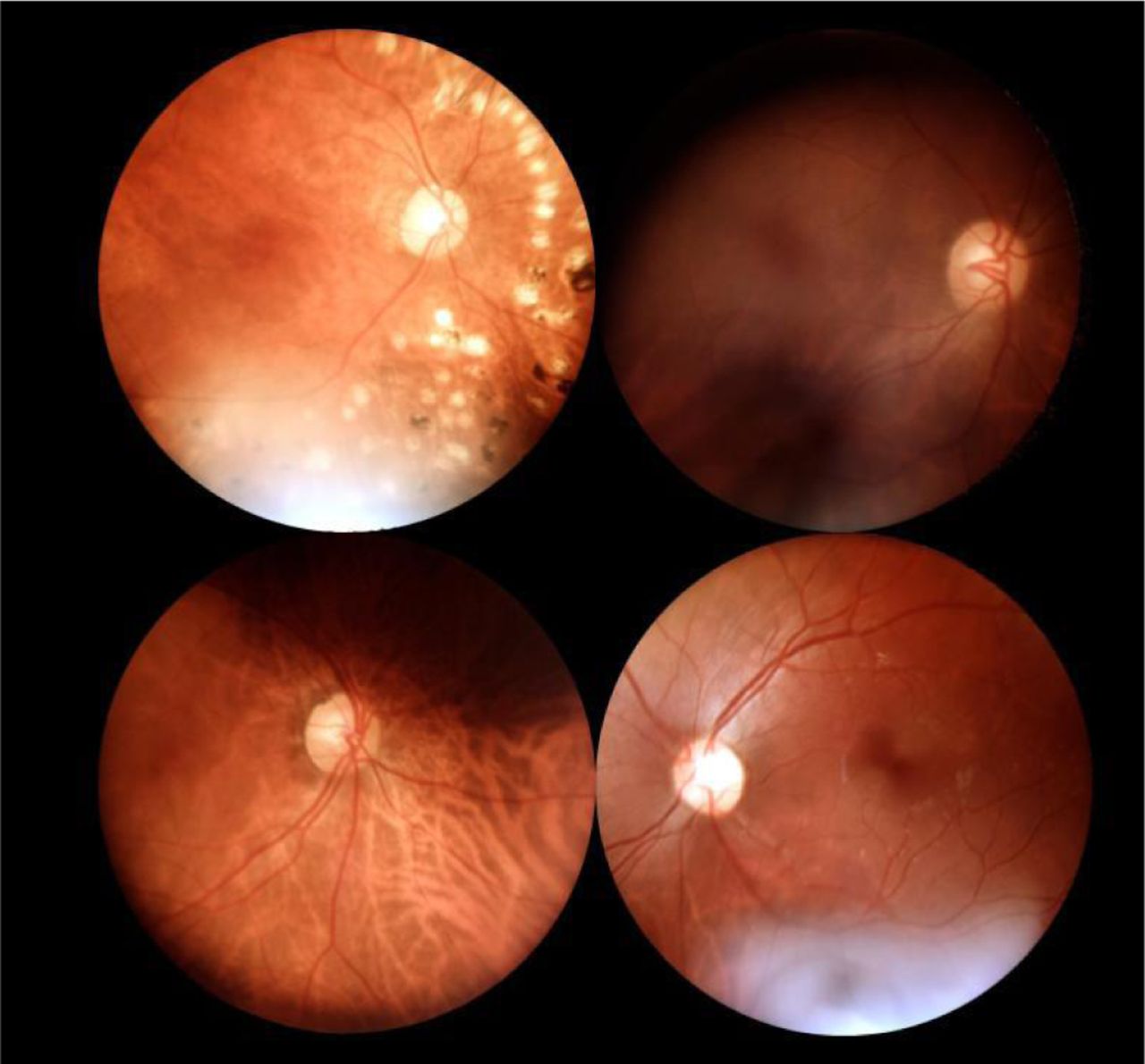 Images with artefacts from mBRSET - illumination and focus.