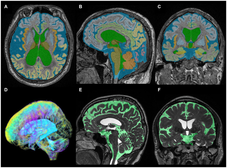 Segmentation from three-dimensional T1- and T2-weighted MRI. The upper axial (A), sagittal (B), and coronal (C) images on 3D T1-weighted MRI show the results for fully automatically segmented regions, including total ventricles (green) and total subarachnoid spaces (marine blue) of a representative patient with Hakim disease and DESH, using the Brain Subregion Analysis application on the 3D volume analyzer SYNAPSE 3D workstation (FUJIFILM Corporation). The lower three-dimensional (D), sagittal (E), and coronal (F) images on 3D T2-weighted MRI show the results of manually segmented total ventricles (light blue in D) and total subarachnoid spaces (light green in E,F) of a representative healthy elderly volunteer.