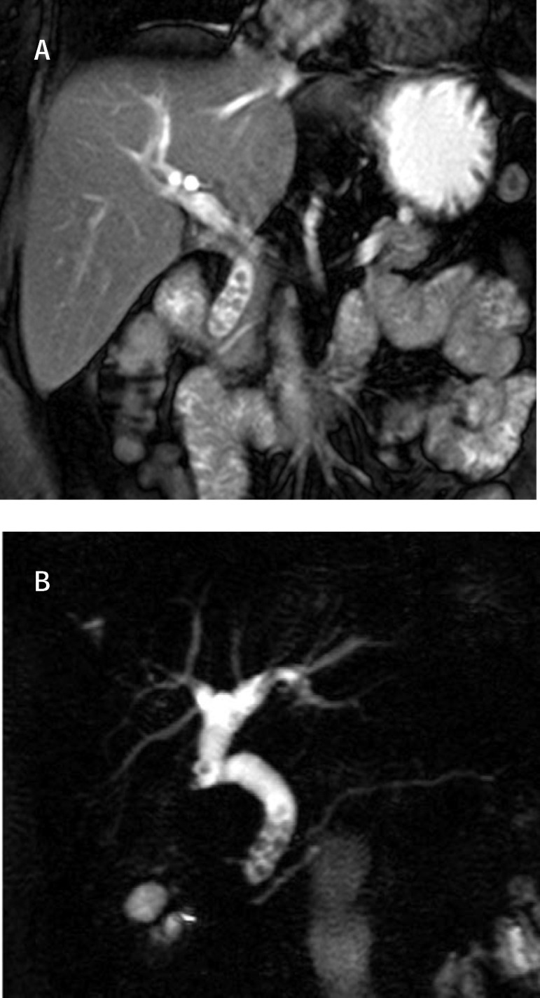 MRCP Multiple stones with dilation