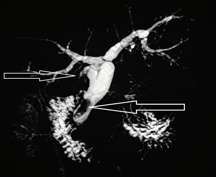 Magnetic resonance cholangiopancreatography (MRCP) demonstrating a distal common bile duct stone with proximal biliary dilatation (arrows indicating the site of the stone), along with a cystic duct stump calculus.