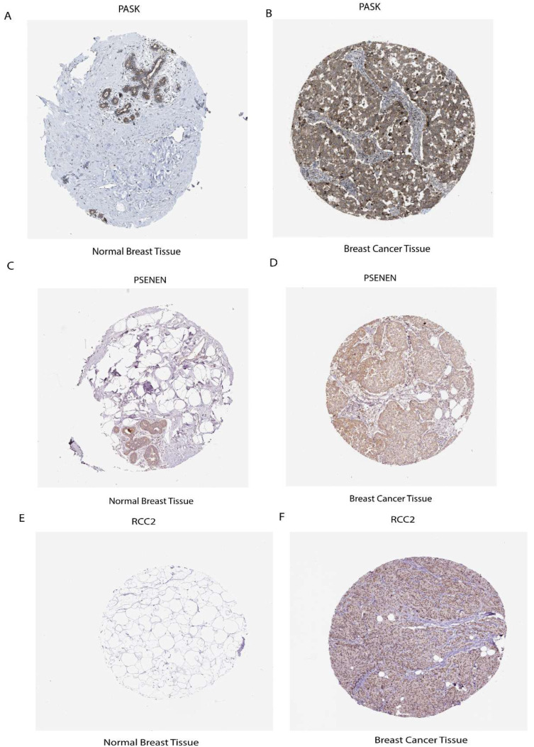 Expression level of mRNA and protein of prognostic risk signature. (A) PASK protein expression level in normal breast tissue (B) and breast cancer tissue. (C) PSENEN expression in normal breast tissue (D) and breast cancer tissue. (E) RCC2 expression in normal breast tissue and (F) in breast cancer tissue.