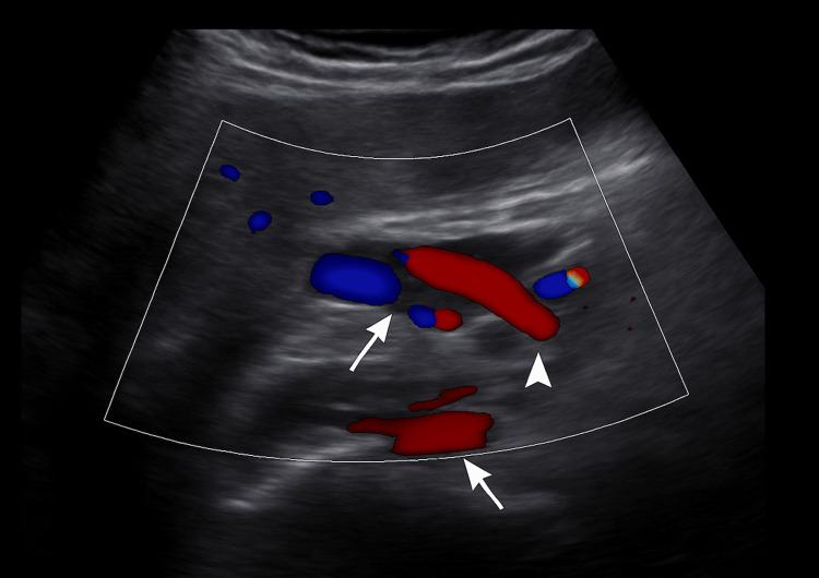 Doppler ultrasound image showing the intrapancreatic portion of the common bile duct (arrow) and the pancreas (arrowhead)
