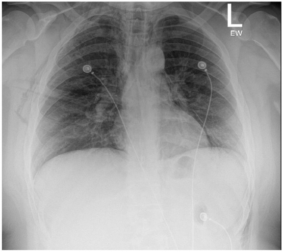 This X-ray displays significant subcutaneous emphysema in both the right and left chest walls extending down to the left lower chest wall, indicative of air leakage in the chest area.