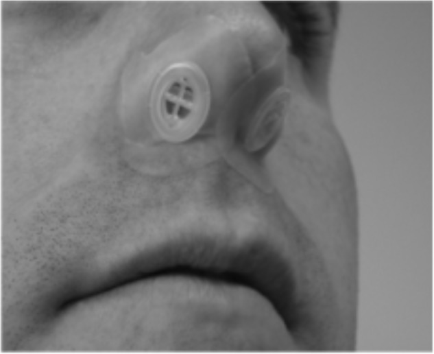 Photograph of the expiratory positive airway pressure device in place.Notes: Reprinted from Sleep Med, 12(2), Walsh JK, Griffin KS, Forst EH, et al. A convenient expiratory positive airway pressure nasal device for the treatment of sleep apnea in patients non-adherent with continuous positive airway pressure, 147–152, Copyright © 2011, with permission from Elsevier.24