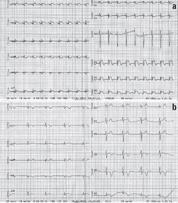 (a) ECG showing RBBB and ST segment elevation in leads DI, II, III, aVL, aVF, and V4-6; (b) Control ECG showing inverted T waves in leads DI, II, aVL, and V4-6 without RBBB