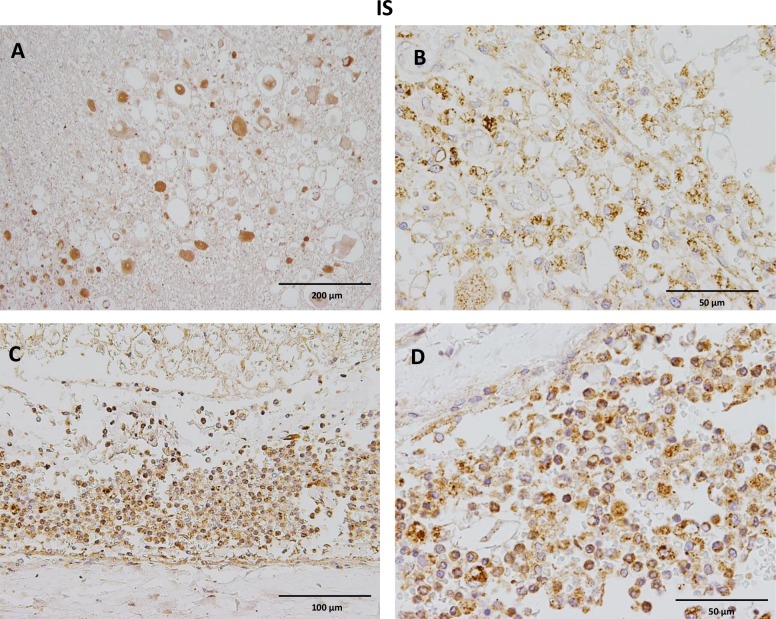 Immunohistochemistry of anti-CB2 antibody in spinal cord lesions of dogs with intraspinal spirocercosis.A) Notice moderate to strong CB2 immunostaining of swollen axons (spheroids) within the white matter. B) Prominent intracytoplasmic staining of large foamy macrophages (gitter cells) with CB2 antibody. C) Severe diffuse infiltration of the subarachnoidal space with strongly CB2 labeled inflammatory cells. D) The CB2 positive leukocyte population mainly consists of macrophages and fewer lymphocytes and plasma cells. IHC was performed using the avidin-biotin-peroxidase complex (ABC) method.
