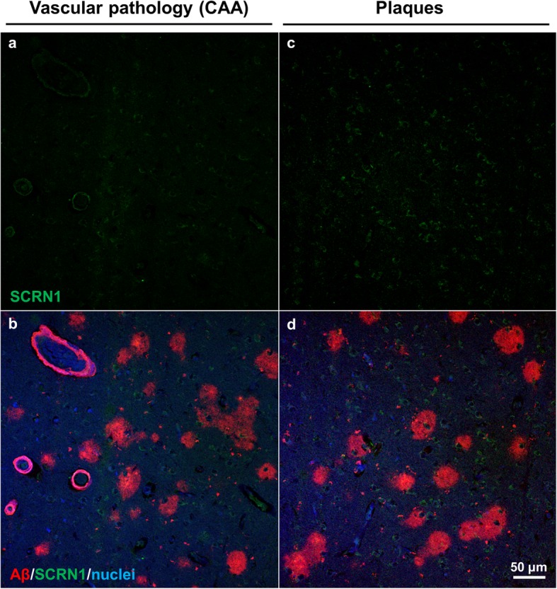 SCRN1 in HCHWA-D. SCRN1/Aβ immunostaining showed no accumulation of SCRN1 in either vascular (a, b) or parenchymal lesions (c, d)