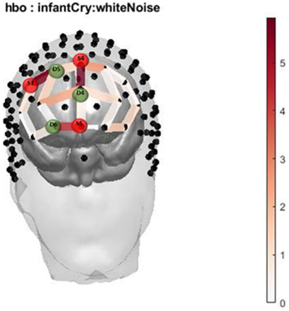 Infant Cry HbO activation. Oxygenated hemoglobin (HbO) levels of activation measured by F state size between groups in relation to location on the prefrontal montage for infant cry and white noise.