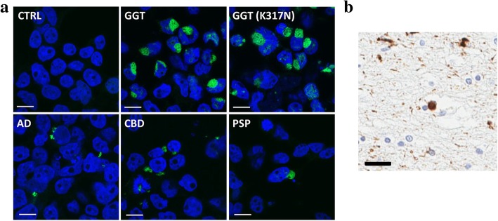 Tau aggregates induced by GGT brain lysates display distinct morphology. a A large, distinctively globular morphology of tau aggregates in the tau biosensor cell line induced by sporadic or mutant GGT brain lysates. Representative confocal images illustrate their markedly different morphology compared to those induced by AD, CBD, or PSP brain lysates (scale bar = 10 μm). b Tau-immunopositive, globular cytoplasmic inclusion in GGT brain sections stained with CP13 p-tau antibody (pS202) (scale bar = 10 μm)