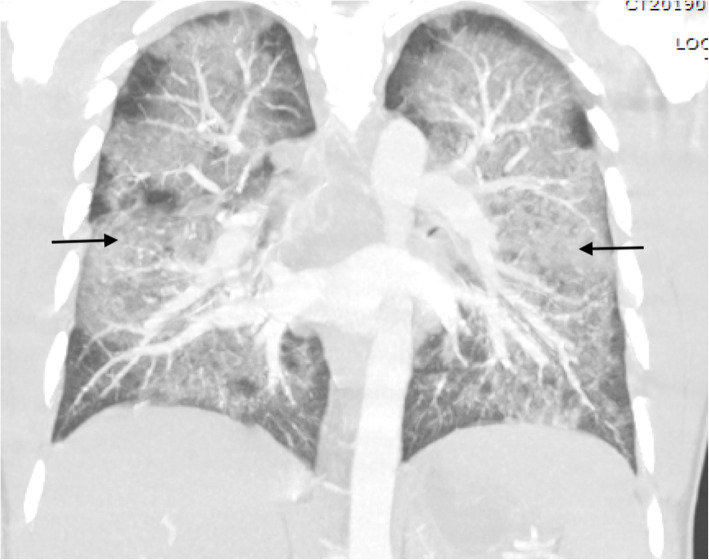 Sagittal view computed tomographic scan further demonstrating diffuse central predominant interstitial opacities (black arrows)