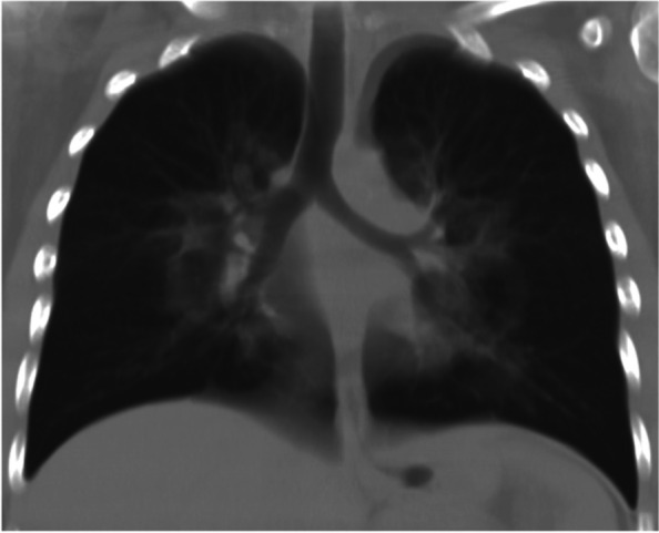 Patient’s CXR showing a central perihilar ground glass