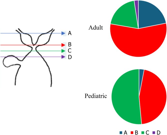 Results of the nationwide expert survey of adult and pediatric institutions on the hepatic hilum‐side transection line in Todani's Type IV‐A CBD. The transection lines were categorized as A–D: A (blue line), above the confluence of the hepatic ducts; B (red line), at the confluence of the hepatic ducts (two holes); C (green line), at the confluence of the hepatic ducts (single hole); and D (purple line), below the confluence, on the duodenal side (dilated portion). In addition, several institutions reported performing ductoplasty in conjunction with bile duct transection.
