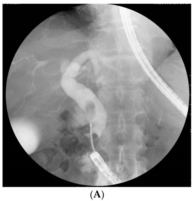 A useful “retroflex position” for stone extraction in a Roux-en-Y gastrectomy patient. (A) At the initial session, the scope was stretched after reaching the papilla (not formed the retroflex position). Following successful biliary cannulation, precutting, and endoscopic papillary large balloon dilation, a stone was able to be grabbed with a mechanical lithotripter. However, complete stone extraction was not able to be conducted using any devices, including a basket catheter or balloon catheter, as the axis of the devices did not align with the distal bile duct during the extraction. (B) In the second session, the retroflex position was obtained by forming a looped-scope shape. In this manner, the coaxial relationship between the devices and the distal bile duct and a proper distance from the tip of the scope to the papilla of Vater with a better view of the papilla could thus be successfully obtained. This situation allowed stones to be easily removed along the axis of the distal bile duct.