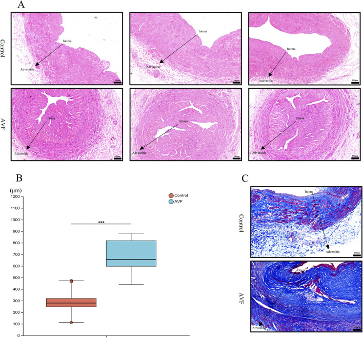 Panel A shows histological sections of blood vessels from control and AVF groups, highlighting the intima and adventitia layers. Panel B is a box plot comparing the thickness of these layers, showing significant differences between control and AVF groups. Panel C displays stained sections, emphasizing structural differences in the intima and adventitia between control and AVF groups.