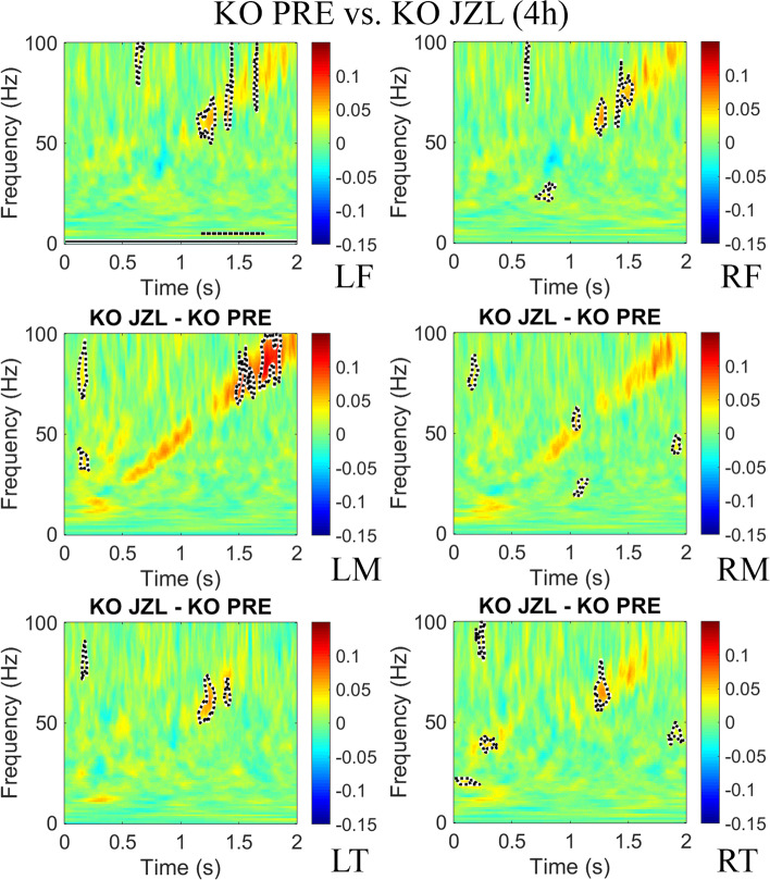 JZL-184 treatment improves inter-trial phase coherence to auditory chirp in Fmr1 KO mice 4 h post-treatment. Graphs show group mean differences between JZL-184-treated Fmr1 KO mice (N = 13) 4 h post-treatment compared with Fmr1 KO mice prior to treatment (N = 22) in left/right frontal, medial, and temporal regions of the mouse cortex. Monte Carlo statistical method on cluster analysis revealed a significant increase (p < 0.025) in average ITPC values in JZL-184-treated Fmr1 KO mice (yellow and red regions with dotted black outline) in the gamma-band range (~ 30–100 Hz) in all regions. Abbreviations: LF, left frontal; RF, right frontal; LM, left medial; RM, right medial; LT, left temporal; RT, right temporal