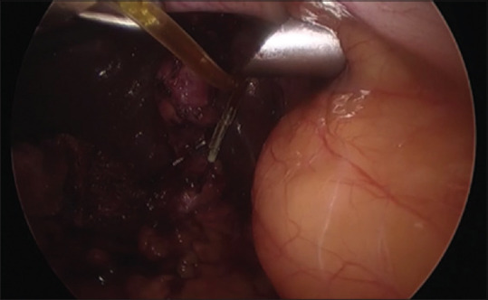 Common bile duct confirmation by aspiration