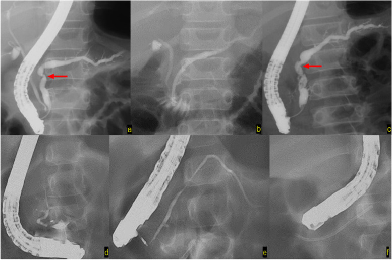 Case 5 (a, b): At the time of the initial endoscopic retrograde cholangiopancreatography, stenosis was found in the main pancreatic duct, as seen in the figure. Pancreatic duct stent placement was performed. c Improvement of stenosis observed at the time of pancreatic duct stent removal. No recurrence of pancreatitis was observed for 14 years and 5 months after stent removal. Case 9 (d) Contrast imaging of the main papilla shows disruption of the Wirsung duct (e) Contrast imaging of the caudal pancreatic duct through contrast imaging of the accessory papilla (f) Stent placement from the accessory papilla to the caudal pancreatic duct Endoscopic minor papilla sphincterotomy was performed, and no recurrence of pancreatitis was observed for 15 months