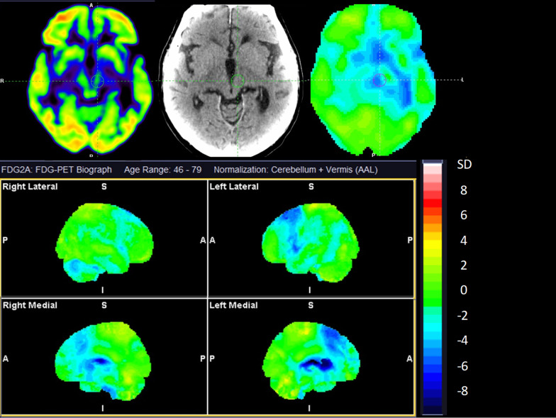 Cerebral [18F]FDG PET of a 73-year-old man with overlapping features of CBD and PSP. Top row show axial sections at the level of the basal ganglia and mesencephalon of [18F]FDG, CT, and statistical maps. The bottom rows show statistical surface projections with standard deviations from healthy subjects. Please note the asymmetry and involvement of the basal ganglia pointing towards CBD and the involvement of mesencephalon and mesial frontal cortex pointing towards PSP