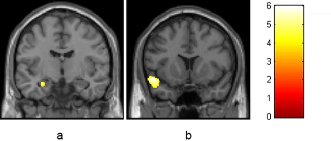 Negative correlation between use per week in grams at follow-up and grey matter volume in the whole brain analysis in the CB group.There are two significant clusters, one in the hippocampus/amygdala (cluster size = 118, pFWE = .044, x,y,z = -27,-10,-20; Fig 2a) and one in the superior temporal gyrus (cluster size = 518, pFWE = .044, x,y,z = -52,11,-15; Fig 2b). Images are coronally depicted in radiological convention (i.e. subject’s left is image’s right).