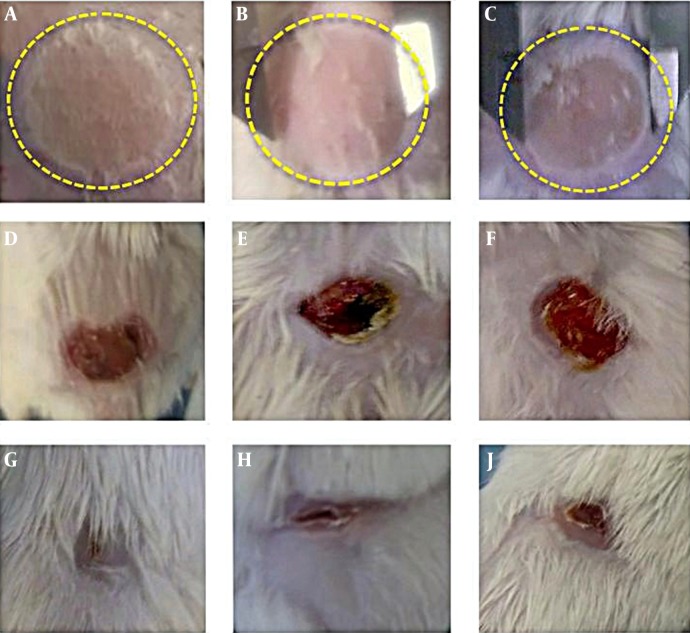 Comparison of Wound Closure Among the NF, Negative Control, and SSD Groups.Representative photographs of the burn wounds at days 1, 12, and 21 after burning in a mouse model. A, NF; B, Negative control; and C, SSD at Day 1. D, NF; E, Negative control; and F, SSD at Day 12. G, NF; H, Negative control; I, SSD at day 21. NF: new formula, SSD: Silver sulfadiazine.