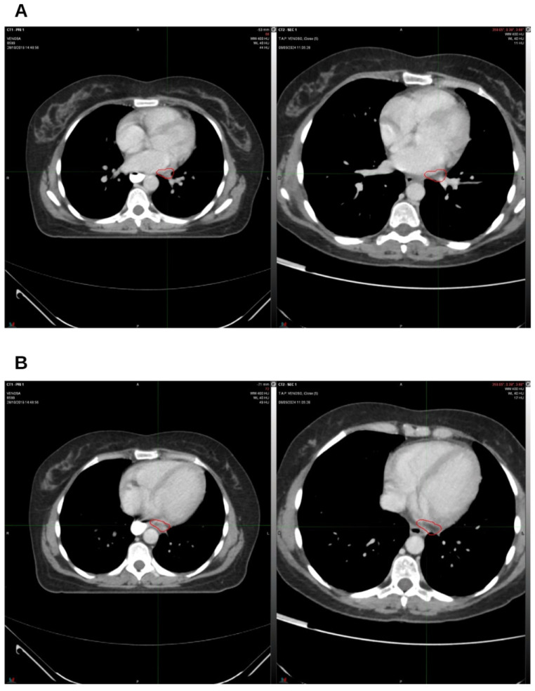 On the left, CT from October 2019, pre-radiation therapy treatment; on the right, CT from November 2023. (A) Hilar lymph node; (B) left para-aortic lymph node. The indicated region highlights the boundary of the treated target.