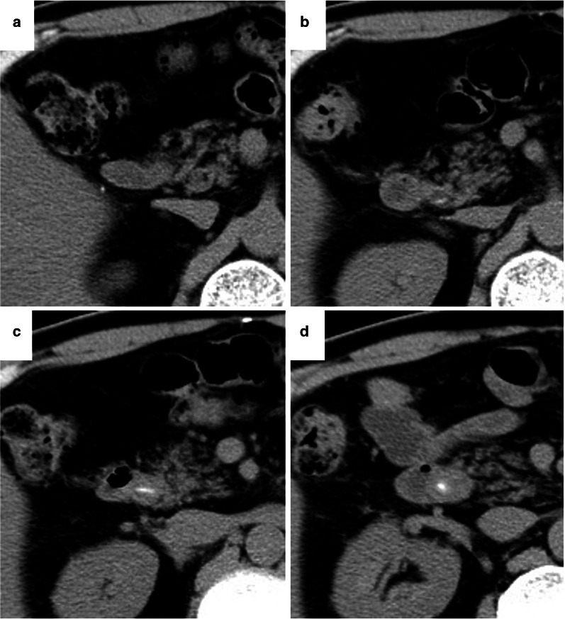 The time series of the surveillance computed tomography (CT) after gastrectomy. In 2012, 7 years after the patient underwent distal gastrectomy with Roux-en-Y reconstruction for gastric cancer, the common bile duct (CBD) stone was not detected (a). In 2015, at the past CT scan review, a spotted high-density area was recognized (b). The stone formation was also recognized in 2016, although the patient had no symptoms (c). CBD dilatation with stone formation causing obstructive jaundice was detected in 2017 (d)