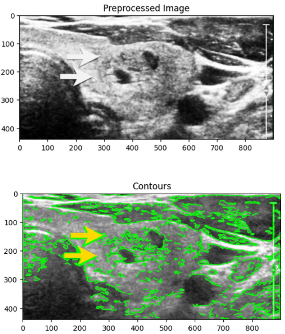 Segmentation of the thyroid region using edge detection and contour detection techniques.