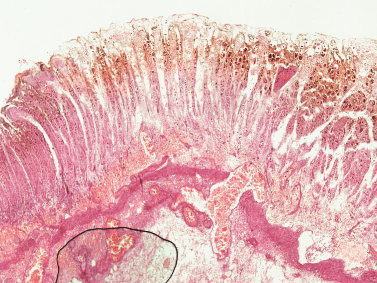 Histology of gastric tissueFull-thickness section of gastric tissue with transmural infarction, necrosis, and many hemosiderin-laden macrophages. Submucosal vessels were dilated and congested, and some were thrombosed. There was an extensive purulent process, extensively destroying the mucosa and submucosa.