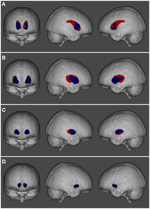 Three-dimensional view showing the spatial localization of volume abnormalities in different regions of the basal ganglia: (A) caudate nucleus, (B) putamen, (C) pallidum, and (D) nucleus accumbens. Basal ganglia structures are depicted in red while regions showing volume alterations are shown in blue.