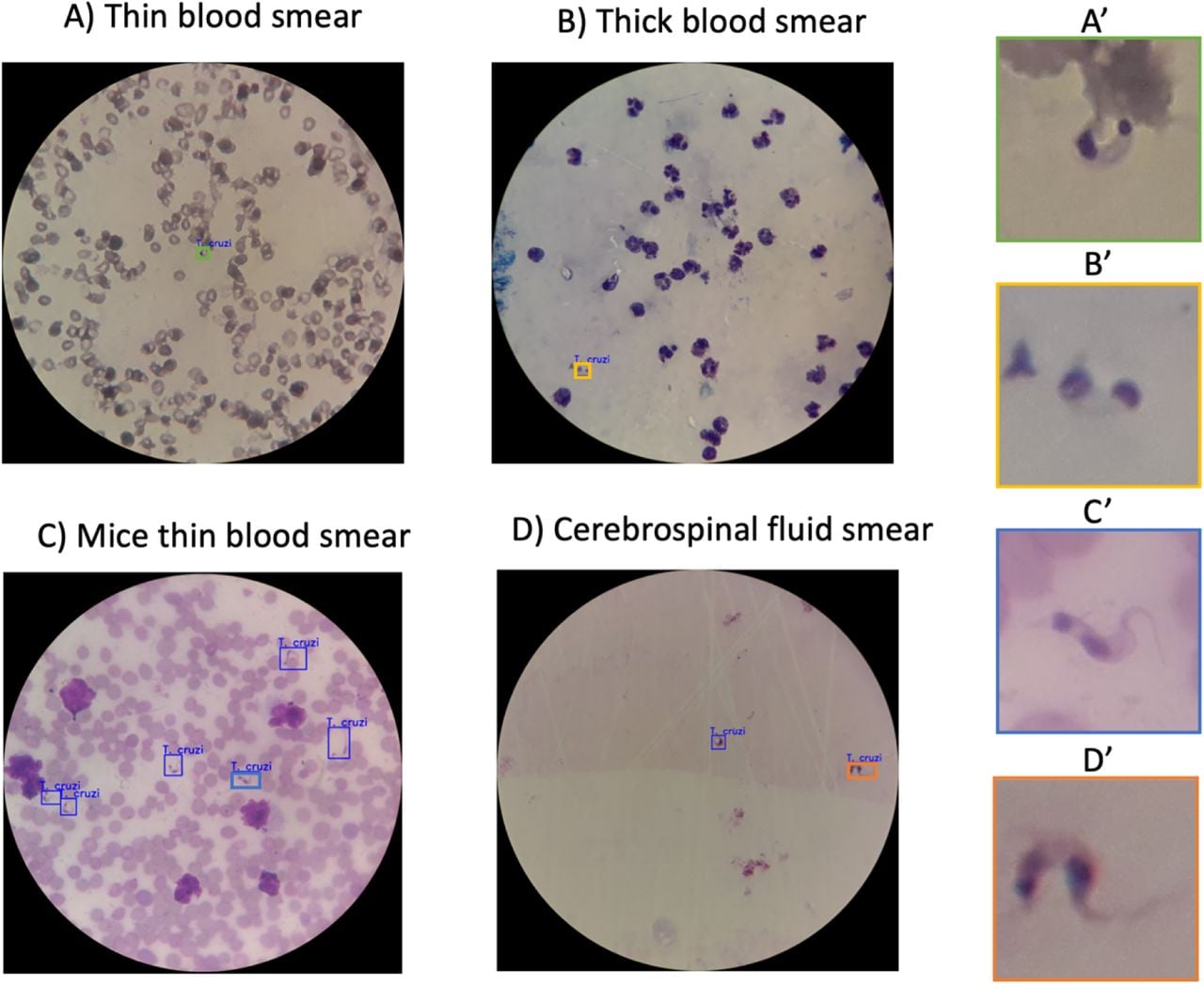 Microscopic images of blood and cerebrospinal fluid samples highlighting field of view and parasite visualization. The left panels display the full field of view for each sample type, while the right panels provide close-up views of parasites identified within the samples. Specifically, A’ shows a parasite from the thin blood smear (Panel A), B’ depicts a parasite from the thick blood smear (Panel B), C’ presents a parasite from the mice thin blood smear (Panel C), and D’ highlights a parasite from the cerebrospinal fluid smear (Panel D).