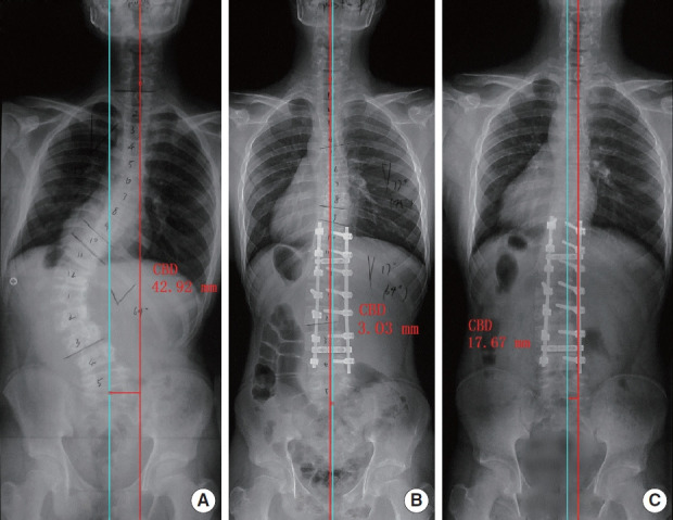 Radiographs of a 15-year-old boy with adolescent idiopathic scoliosis in type B preoperative coronal pattern (A), after surgery (B) immediately, coronal balance was maintained well, the coronal balance distance (CBD) was worsened at 3-year follow-up (C), but still within normal range. Type B, CBD≥20 mm and coronal C7 plumbline shifts to the concave side of the curve.