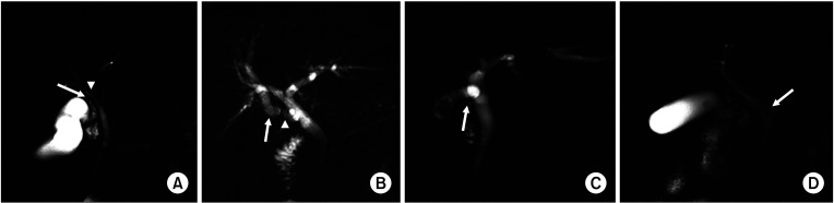 Magnetic resonance cholangiography images demonstrate bile duct anomaly that can cause injury. (A) Aberrant drainage of the cystic duct (arrow) to the right hepatic duct (arrowhead). (B) Aberrant drainage of the right anterior hepatic duct (arrow) to the cystic duct (arrowhead). (C) Short cystic duct (length, <5 mm; arrow). (D) Long, posterior spiral course of cystic duct with medial insertion to common bile duct (arrow).