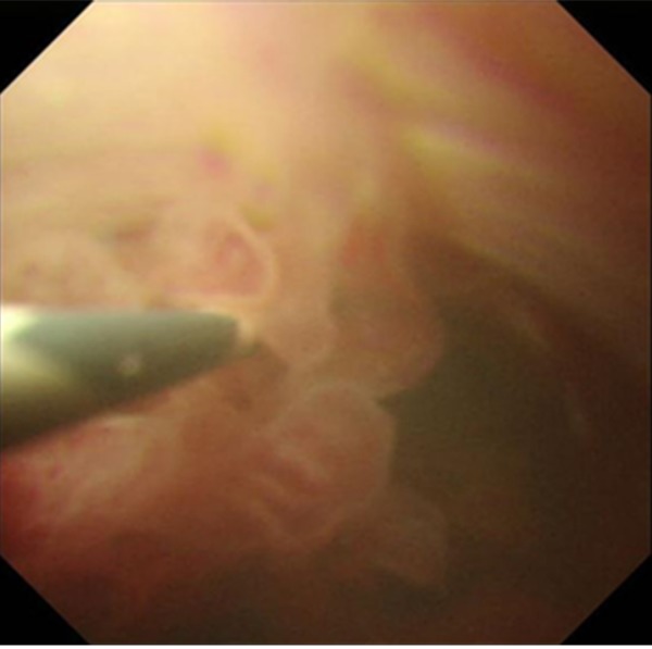 Peroral cholangioscopy findings: Biliary papillomatosis in the common bile duct.