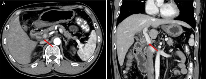 Enhanced CT scan images after EST. Enhanced CT scan showing improved dilation of the CBD and enhanced wall thickness (arrows) of the bile duct measuring 25 × 10 mm at the union of the cystic and common hepatic ducts (a, b)