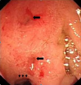 View of deformed bulbus due to chronic ulceration. Wall deformity and narrowing of the lumen (arrow heads). Arrows indicate openings of CBD (upper) and PD (lower).