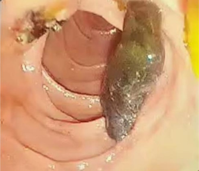The release of a stone approximately 3 cm by 1 cm into the duodenum following sphincterotomy.
