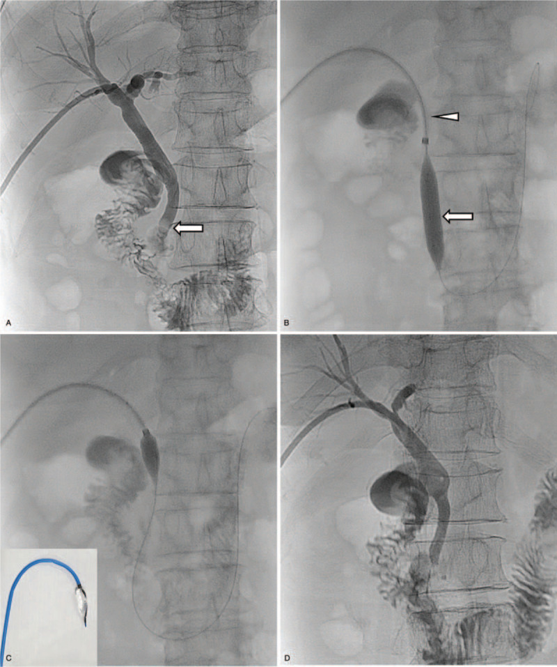 A 69-year-old woman with common bile duct (CBD) stones and related right upper quadrant pain. (A) Percutaneous transhepatic biliary drainage was performed before 4 days. Cholangiography shows distal CBD stones (arrow) up to 1.3 cm. (B) After inserting an 8-Fr sheath (arrowhead) through the transhepatic route, the ampullary sphincter is dilated using a 12mm-diameter × 4cm-length balloon catheter (arrow). (C) The half-captured balloon is located at the proximal CBD. Photograph shows a half-captured balloon catheter within the introducer sheath (Inset). The stones were completely pushed over the 0.035-inch wire into the duodenum. (D) Cholangiogram showing complete clearance of the stones.