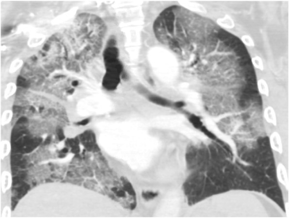Computed Tomography coronal image through the chest of a patient wih EVALI showing bilateraly patchy ground glass opacities