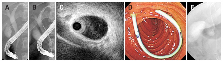Endoscopic biliary drainage using a 5F plastic stent without endoscopic sphincterotomy (EST). Cholangiogram showing (A) no definite stone in a gallstone patient with cholangitis. (B) Intraductal ultrasonography (IDUS) was performed for the detection of common bile duct (CBD) stones. (C) IDUS showing negative finding of CBD stones or sludge. (D) Endoscopic view showing an inserted 5F plastic stent without EST. (E) Cholangiogram showing a 5F plastic stent inserted into the bile duct.